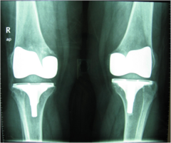 <p>Αμφοτερόπλευρη ολική αρθροπλαστική γόνατος</p>
